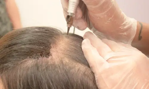 women micro scalp service